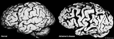 An image of a regular brain (left) compared to a brain of a person with Alzheimer's disease (right).